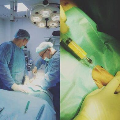 L'épaississement du pénis est possible avec l'aide de la chirurgie.